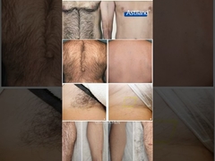 Laser ontharing voor en na