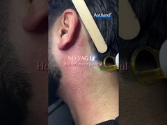 Diode laser versus ND YAG laser, welke heb je liever?